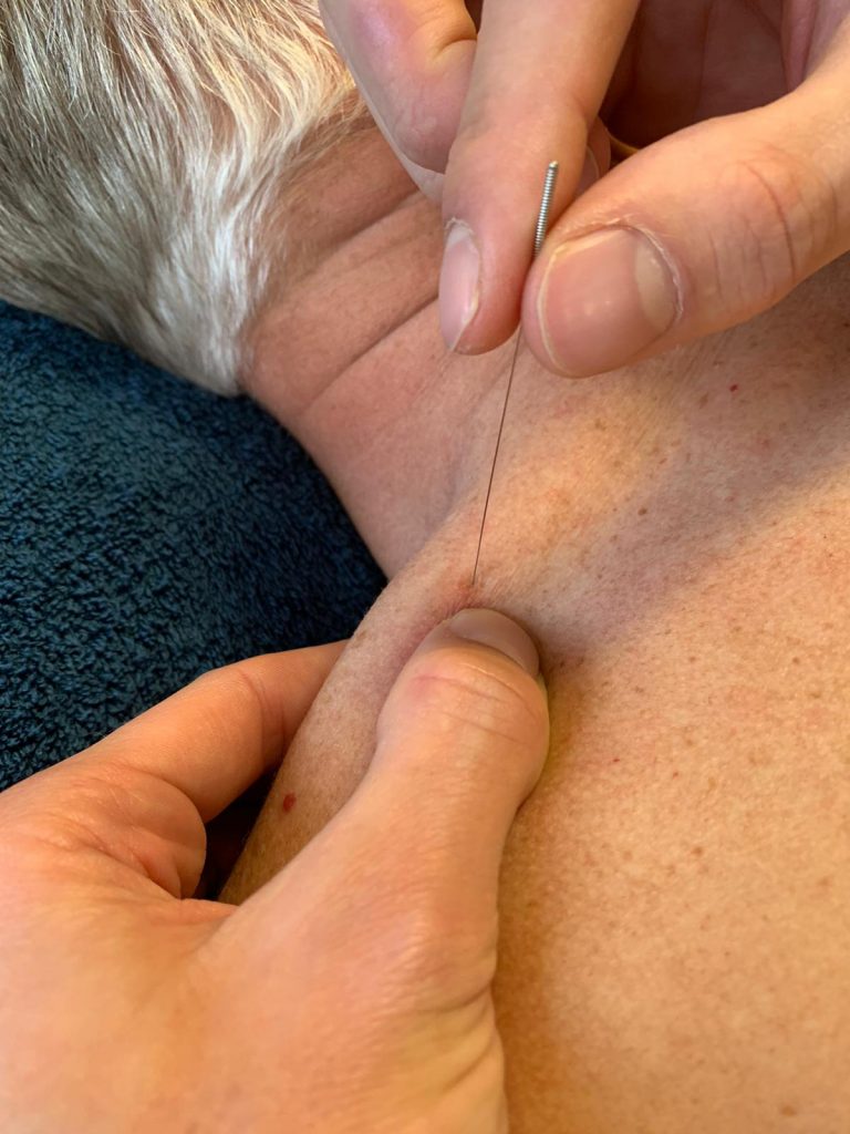 Busser Tjoonk fysio- en manuele therapie dry needling